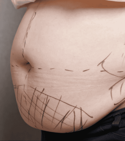 liposucción-lipotransferencia-lipovaser-marcaciónabdimnila-en Armenia Quindío